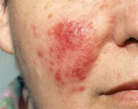 What Causes Red Blood Spots On My Skin Quora