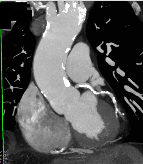 Aneurysmal Dilatation Of Ascending And Descending Thoracic Aorta