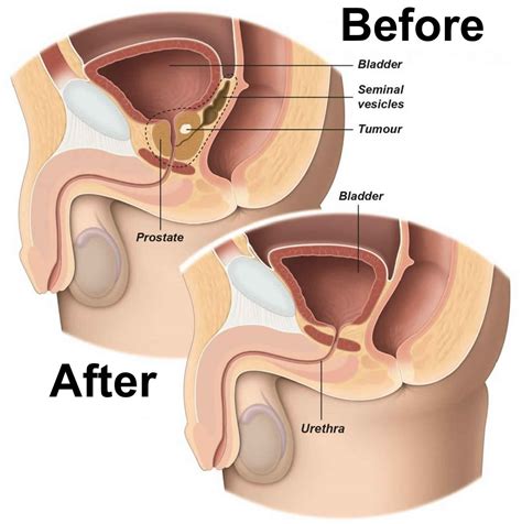 Radical Prostatectomy Procedure Radical Prostatectomy Side Effects