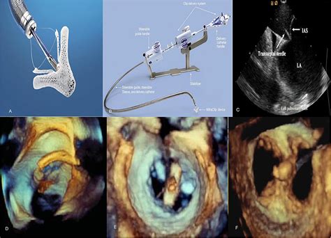 Frontiers Percutaneous Mitral Valve Interventions Repair Current