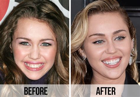 Celebrity Dental Implants And Veneers Before And After Shefinds