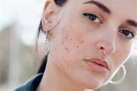 Types Of Acne On Face Background Acne Problems