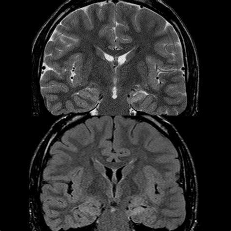 Pediatric Mesial Temporal Sclerosis Pediatric Radiology Reference