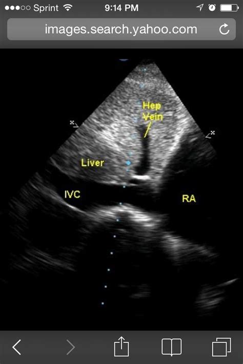 Subcostal View With Ivc In The Ra Ultrasound Sonography