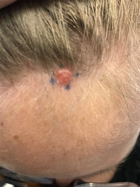 Cancer Bumps On Skin