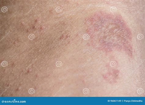 Rash On Sensitive Skin Stock Image Image Of Pink Itch 96061149