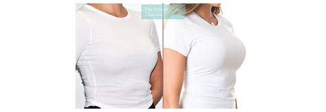 breast enlargement surgery london breast implants uk cost before and after photos