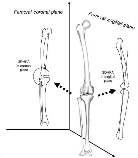 Schematic Illustration Of Coronal And Sagittal Alignment In A Three