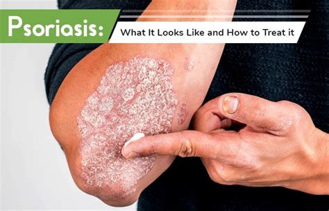 Psoriasis What It Looks Like And How To Treat It Ws Dermatology
