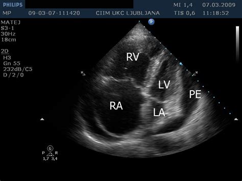 Echocardiography Of Isolated Subacute Left Heart Tamponade In A Patient