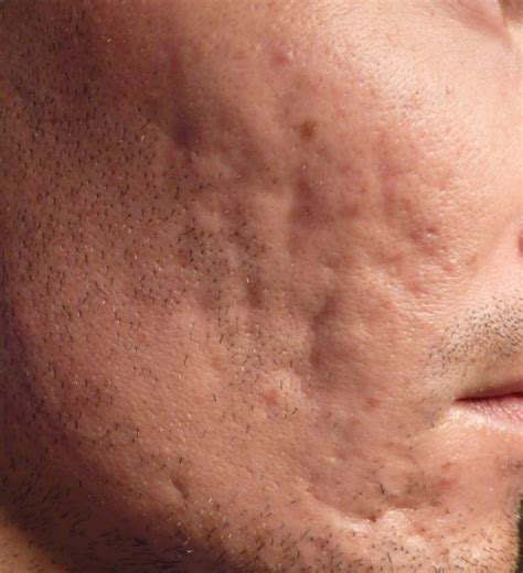 Tratamiento láser para quitar marcas de acné. Laser CO2 fractionné cicatrices acné en creux - Page : 2 ...