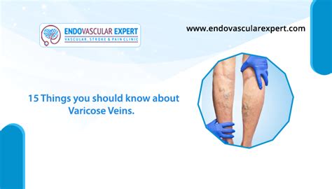 15 Things You Should Know About Varicose Veins Dr Nikhil Bansal