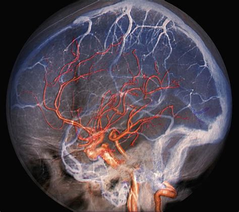 An extraordinary degree of branching of blood vessels exists within the human body, which ensures that nearly every cell in the body lies within a short distance from at least one of. Brain Blood Vessels Photograph by Zephyr/science Photo Library