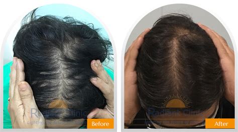 Laser Hair Growth Treatment In Ahmedabad Best Hair Doctor In Ahmedabad