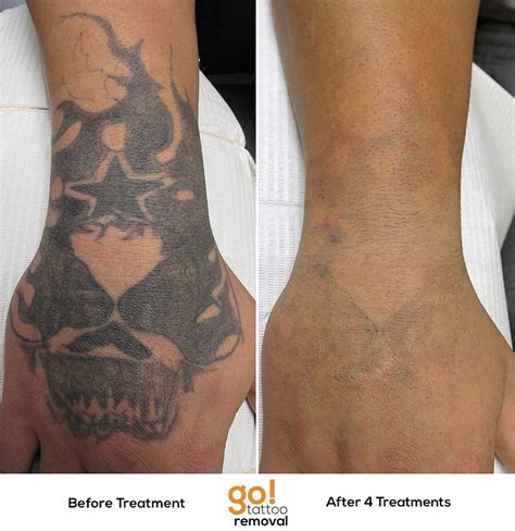 Although other methods of tattoo removal could leave visible scars, the picoway laser does not! Laser Tattoo Removal Leave Scars - Best Tattoo Ideas