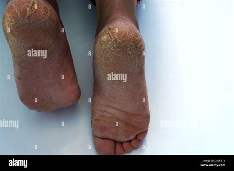 Extremely Dry Feet Showing Cracked Heel In Woman Stock Photo Alamy