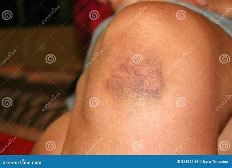 The Bruise On His Knee The Bruise On His Leg Stock Photo Image Of