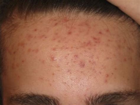 Forehead Acne Causes And Treatments Mdacne