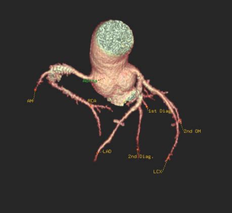 Small branches dive into the heart muscle to. Coronary CT Angiography- Anatomical Considerations - Sumer's Radiology Blog