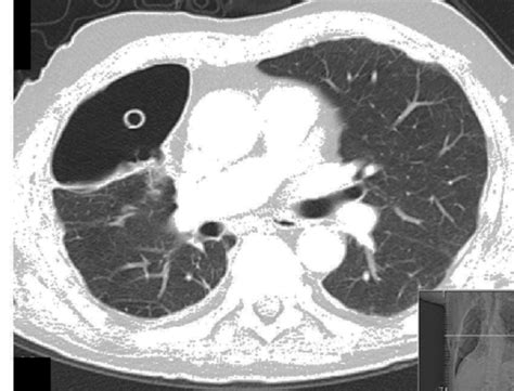 Thoracic Ct Scan Showing Pleural Cavity With A Chest Tube Inside And