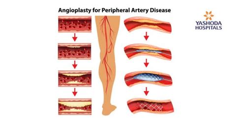 How To Treat And Prevent Peripheral Vascular Disease