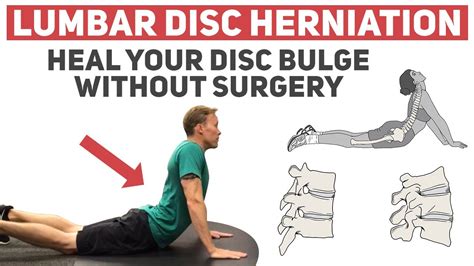 How to Heal Your Disc Herniation Without Surgery - YouTube