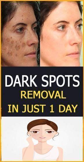 Black Spots On Face Dark Spots On Legs Brown Spots On Skin Skin Care