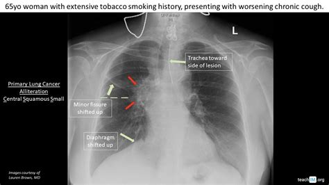 Hilar Mass Primary Lung Cancer Teachim