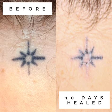 Tattoo Healing Timeline Pictures Insyaf