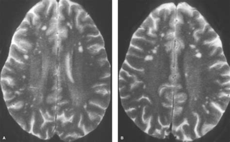 Van der knaap disease (megaloencephalic vanishing white matter disease:ashkenazi. White Matter and Neurodegenerative Diseases | Radiology Key