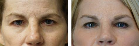 Opera Lift Face Lift Before And After Photos By Dr Lewis J Obi In