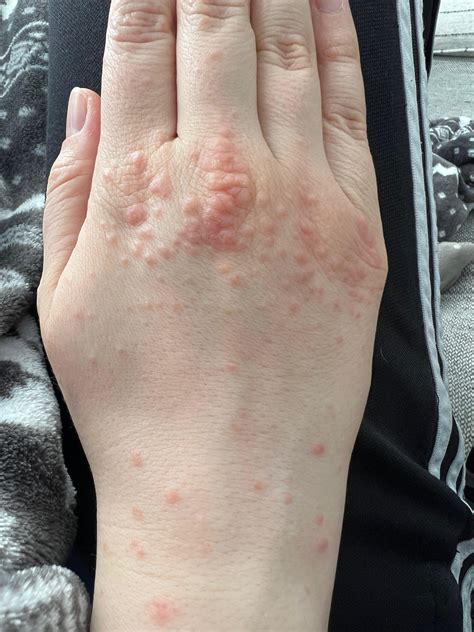 Slightly Itchy Spots On Hands Down To Wrists Rdermatologyquestions