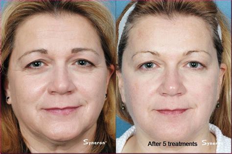 Non Surgical Face Lift Botox Restylane Juvederm Facelifts