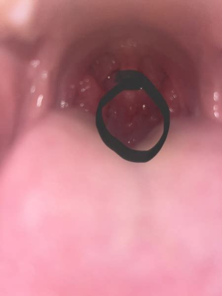 What Are These Lumps At The Back Of My Throat Warning Horrible Tonsil