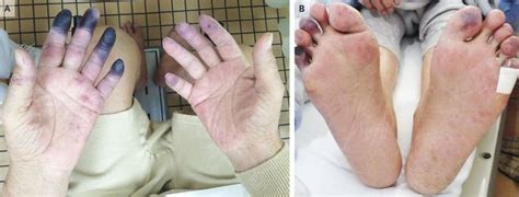 Necrosis Of The Fingers And Toes MEDizzy