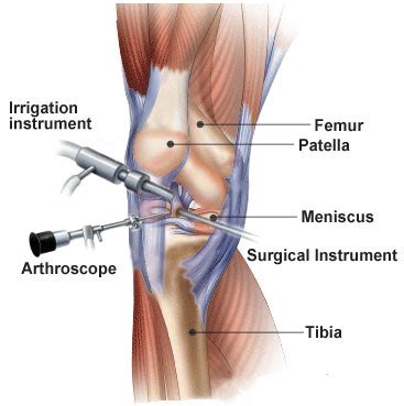 Injury to the anterior cruciate ligament (acl) is the most common ligament injury in the knee. ACL Reconstruction Surgery What you Can Expect