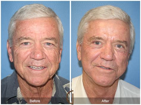 facelift male before and after photos patient 20 dr kevin sadati