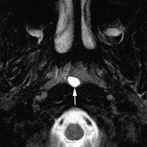 Pdf Nasopharyngeal Cystic Lesions Tornwaldt And Mucous Retention