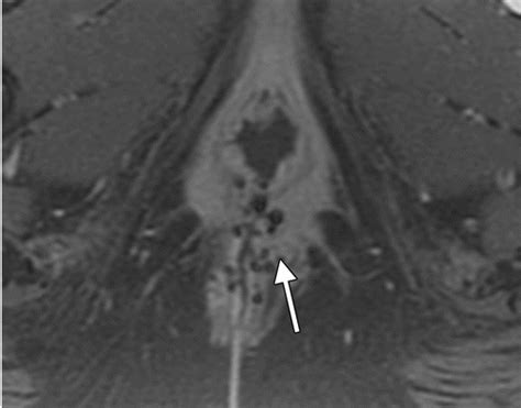 Imaging And Surgical Management Of Anorectal Vaginal Fistulas
