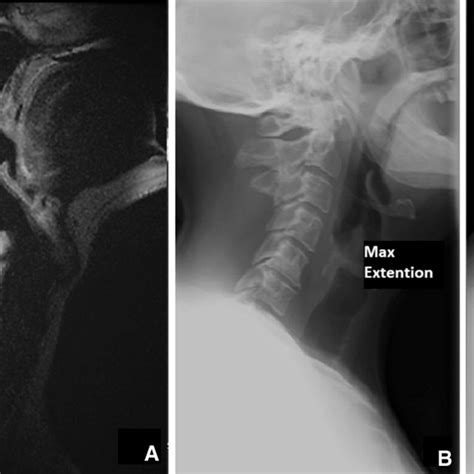Preoperative Mri Of A Year Old Male Patient With Spondylotic