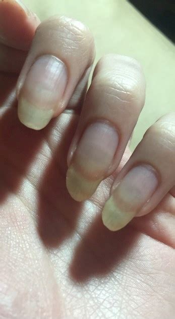 Can Lupus Affect Fingernails Tutorial Pics