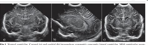 Figure 1 From Neonatal Head Ultrasound Systematic Approach To