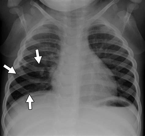 Unilateral Hyperlucent Lung In Children Ajr