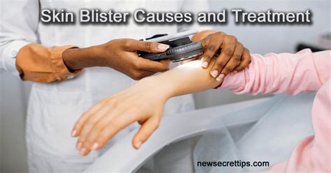Skin Blister Causes And Treatment Options New Secret Tips