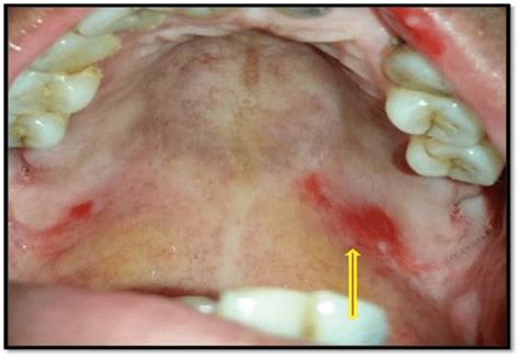 Diffuse Erythematous Lesion On Palate Without Vesicles Download