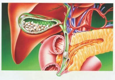 Associata all'assunzione giornaliera di almeno 1 litro di acqua. Consigli alimentari per calcoli alla cistifellea