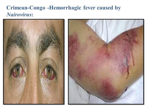 Signs and symptoms typically begin abruptly within five to 10 days of infection with ebola virus or marburg virus. haemorrhagic fever - Liberal Dictionary
