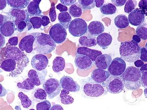 Acute Myelomonocytic Leukemia 3