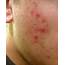 Skin Concerns Suddenly Developed A Strange Heat Rash/hives Type Of 