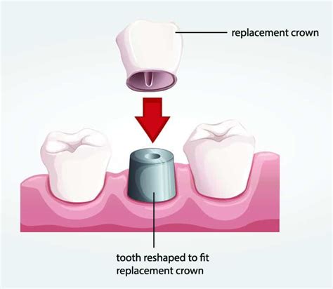 If your dental insurance covers a portion of your crown, the company may send you a bill for your share of the cost after your procedure. Dental Crowns | Dental Knowledge Center | DentalSave Dental Plans
